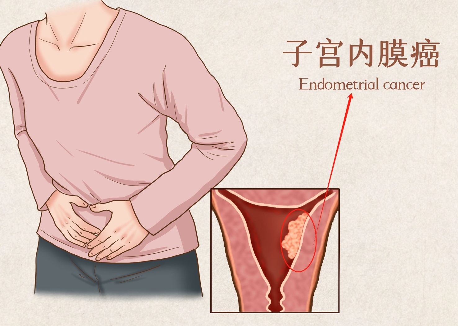 子宫内膜癌发病，多与这些因素有关！