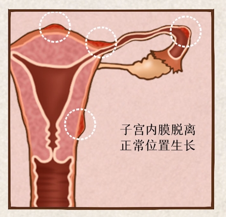 三分钟带你了解子宫内膜异位症