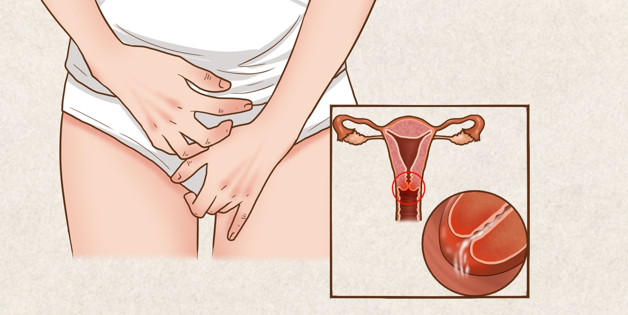 宫颈炎的四大发病原因