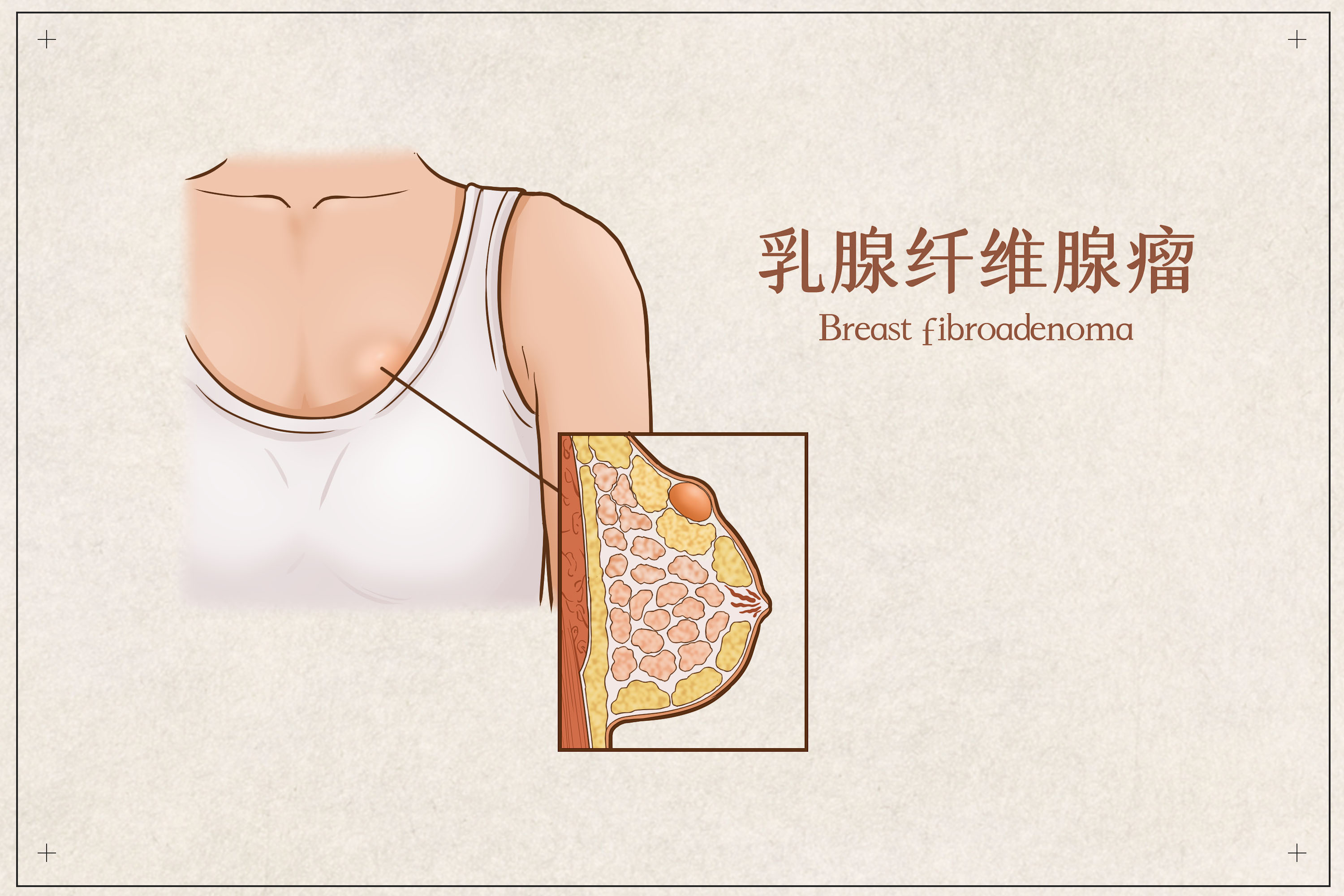 乳房摸到肿块就是乳腺癌吗？别担心，这些常见原因你可能不知道