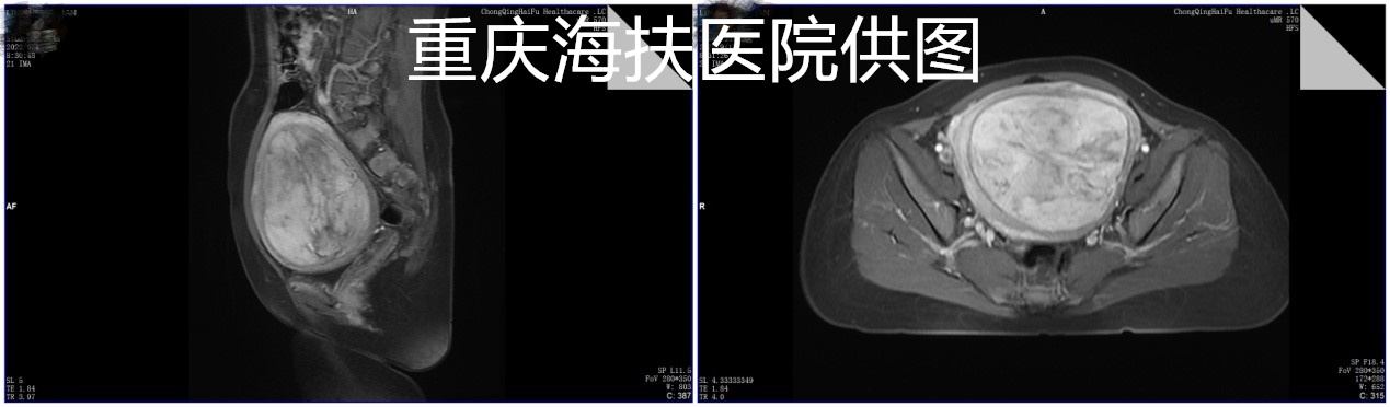 近13cm巨大子宫肌瘤，不是只有开刀一种选择