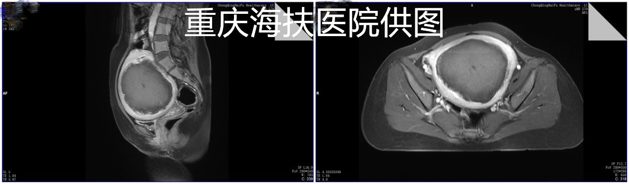 近13cm巨大子宫肌瘤，不是只有开刀一种选择