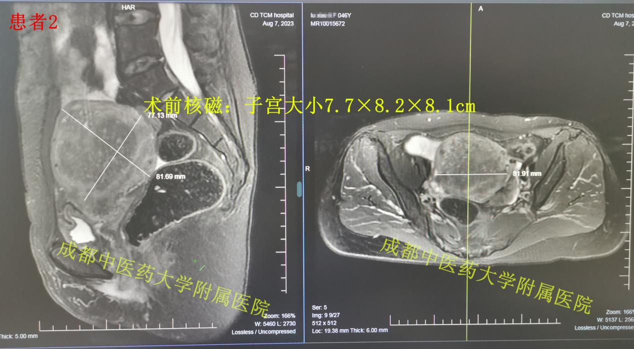 子宫腺肌病，海扶和非海扶治疗效果真的不一样！