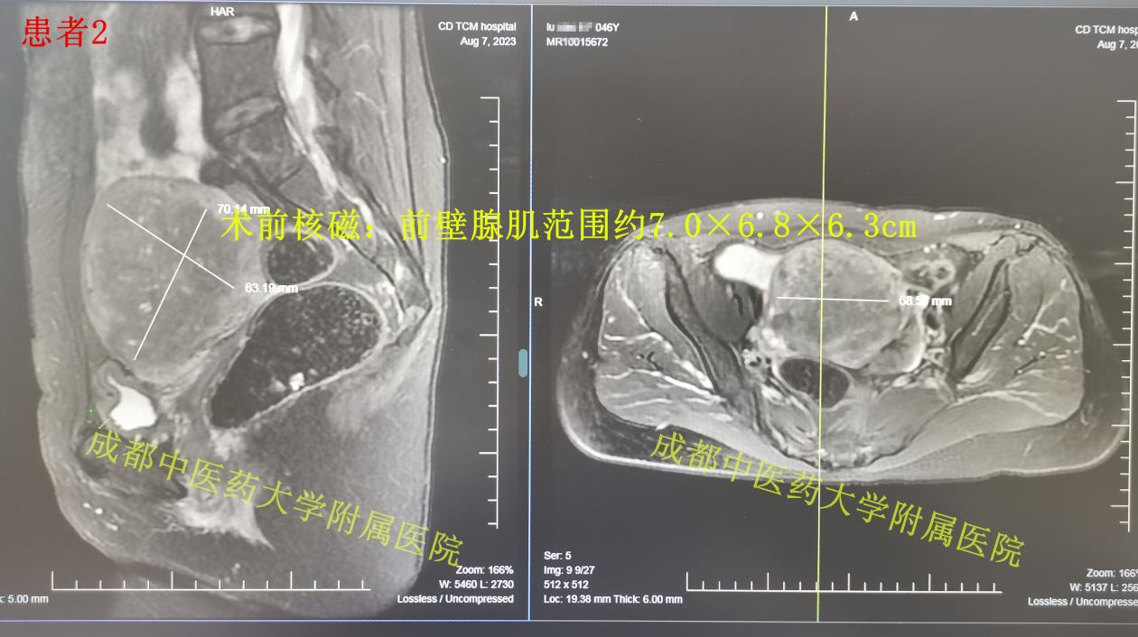 子宫腺肌病，海扶和非海扶治疗效果真的不一样！