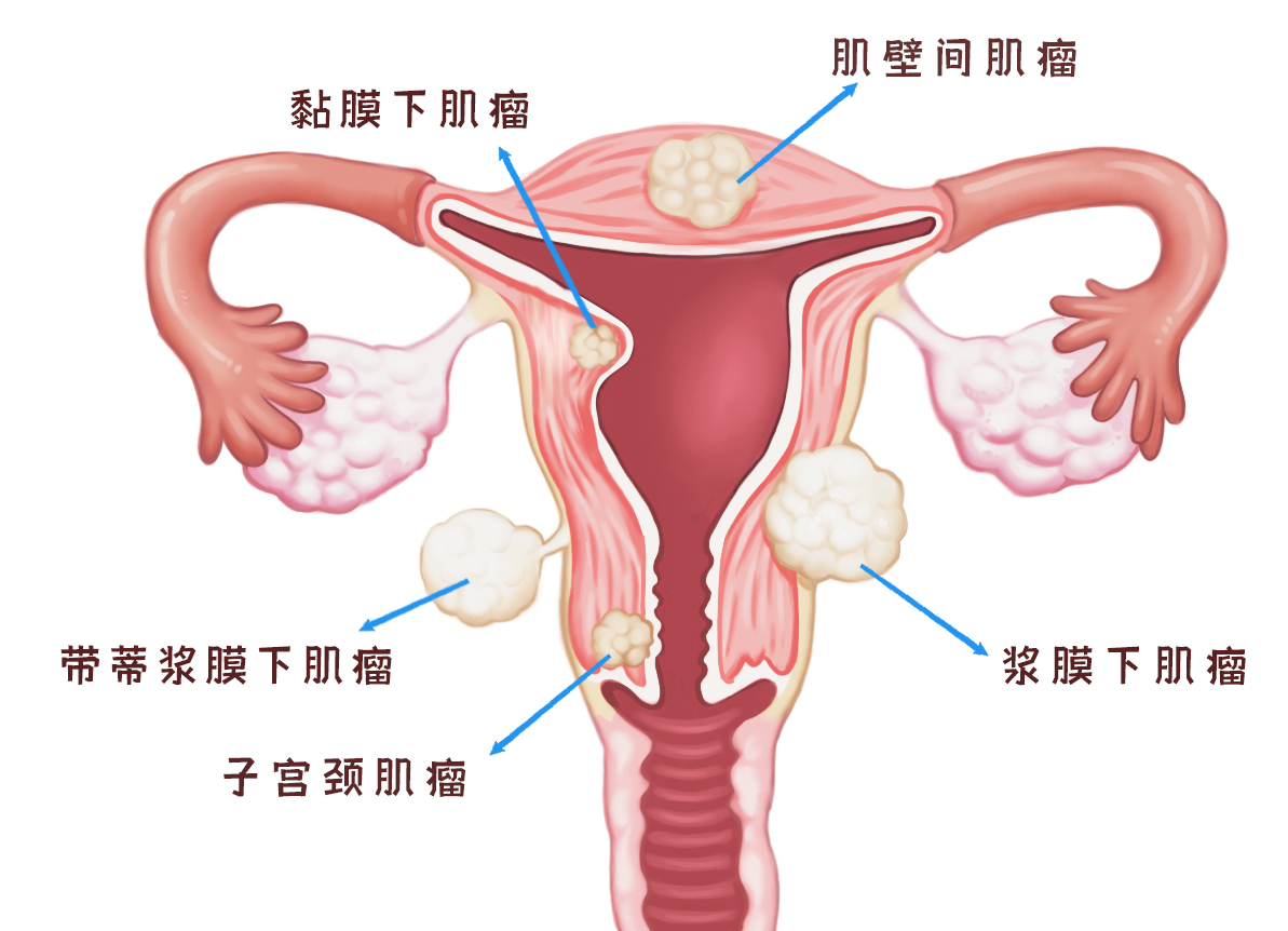 子宫肌瘤哪个位置影响最大？