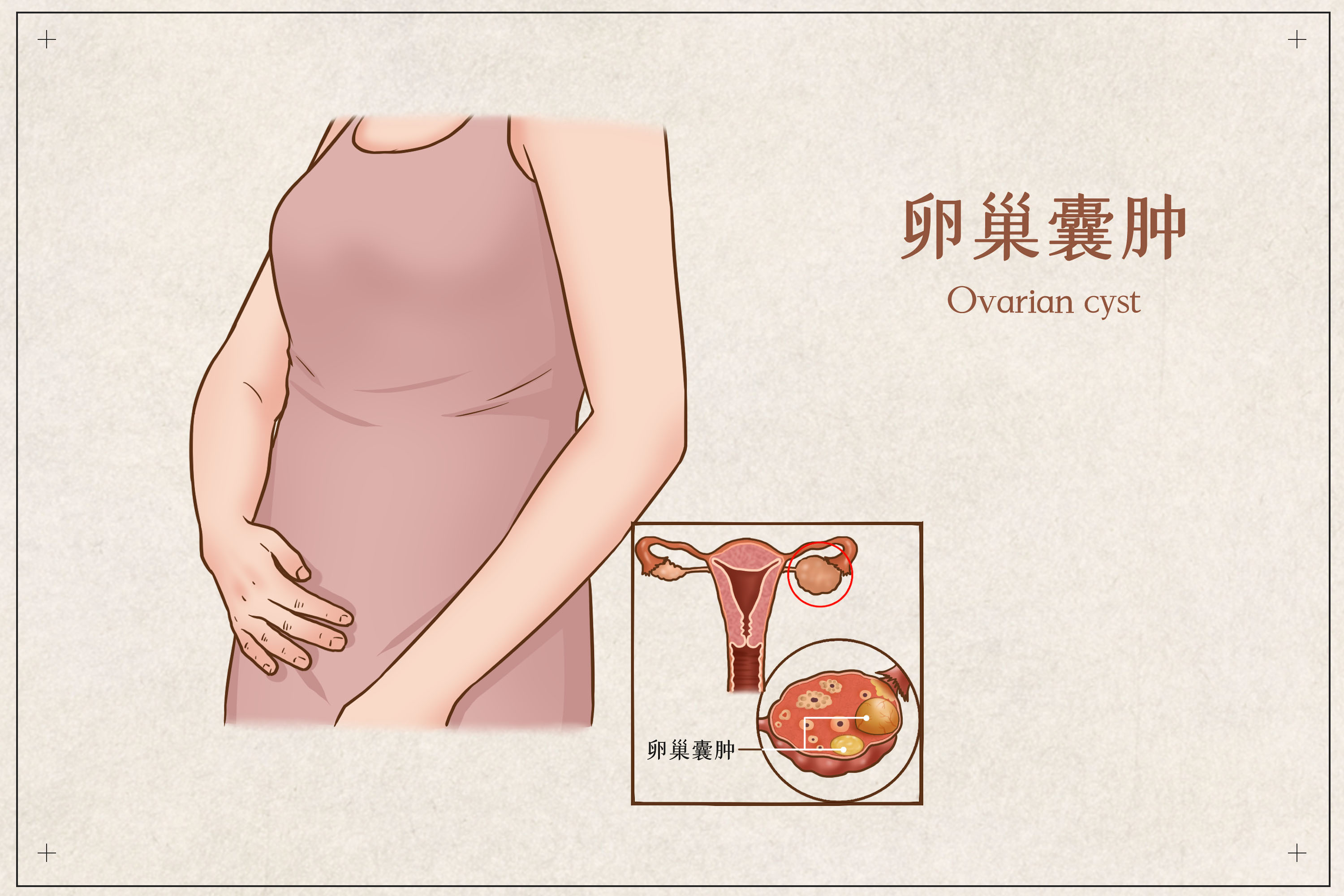 卵巢囊肿的症状有哪些？如何治疗？
