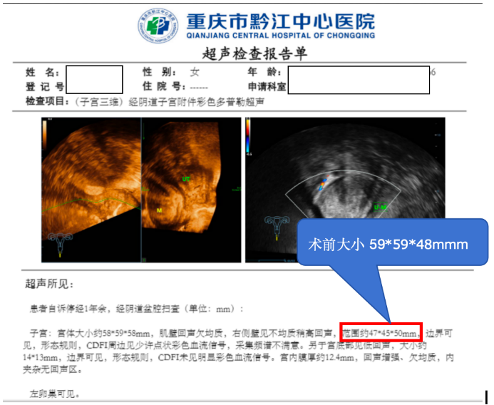 重庆大学附属黔江医院实现渝东南无创子宫肌瘤治疗新突破