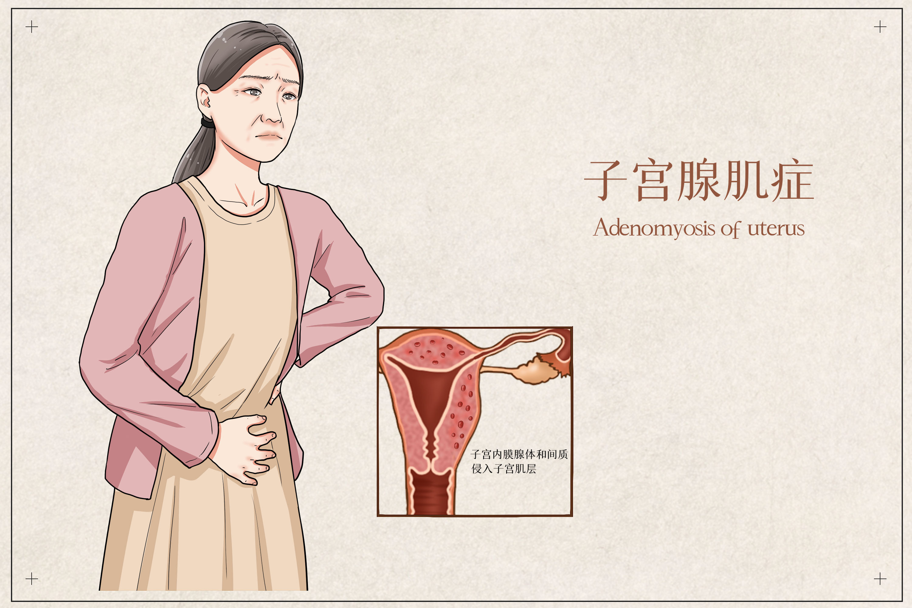 子宫腺肌病对女性健康的影响