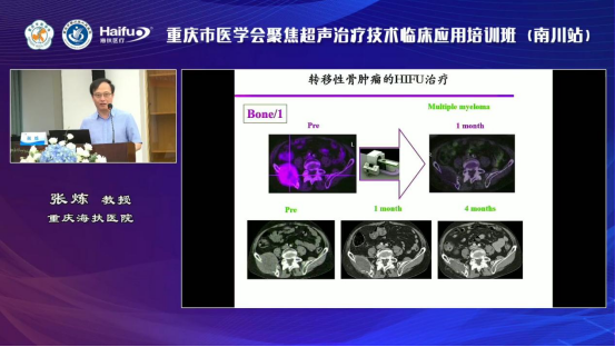 重庆海扶医院院长张炼教授：多种良恶性肿瘤的聚焦超声消融手术临床应用