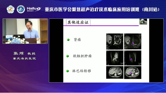 重庆海扶医院院长张炼教授：多种良恶性肿瘤的聚焦超声消融手术临床应用