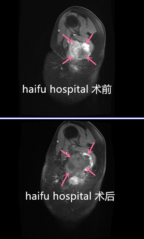 胸壁纤维瘤反复复发，只能反复开刀吗？