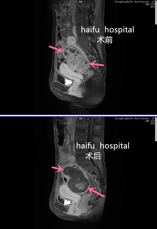 海扶刀®设备治疗巨大盆腔平滑肌肉瘤