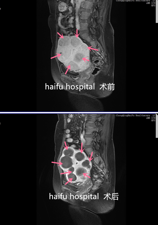 养瘤18年，经量增多还尿频……