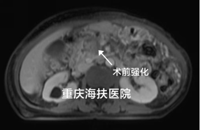 58分钟，不开刀治疗癌种之王——胰腺癌！