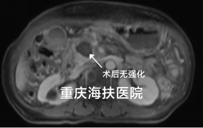 58分钟，不开刀治疗癌种之王——胰腺癌！