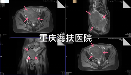 飞跃9000多公里，乌干达巨大肿瘤患者来渝寻求无创治疗