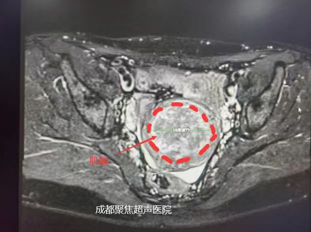 子宫肌瘤缩小87%，C女士是如何实现的？