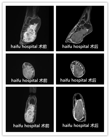 足底肿块切了又复发面临截肢，无创治疗来帮忙