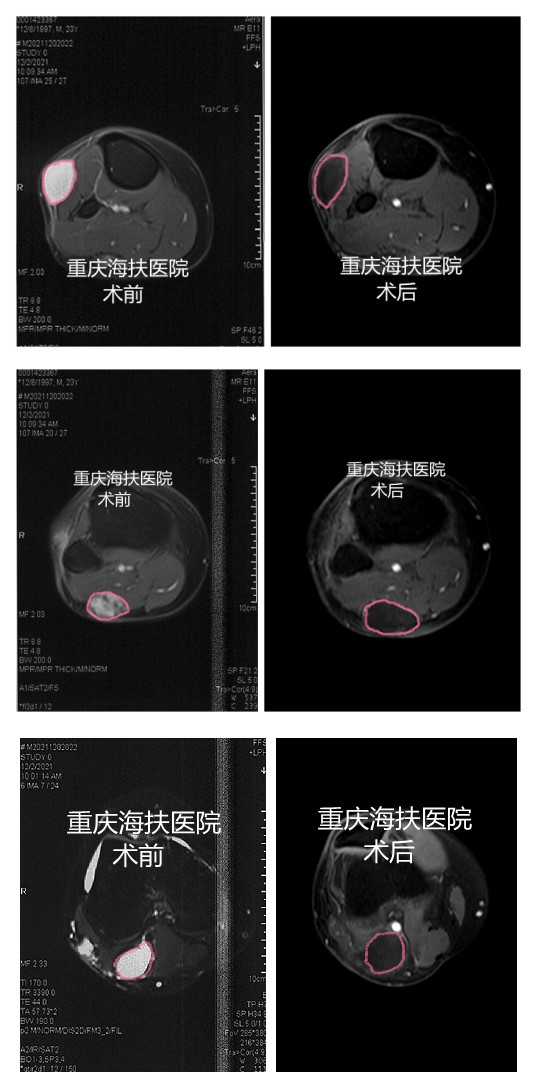 多次切除仍复发，海扶刀设备帮助小伙避免截肢