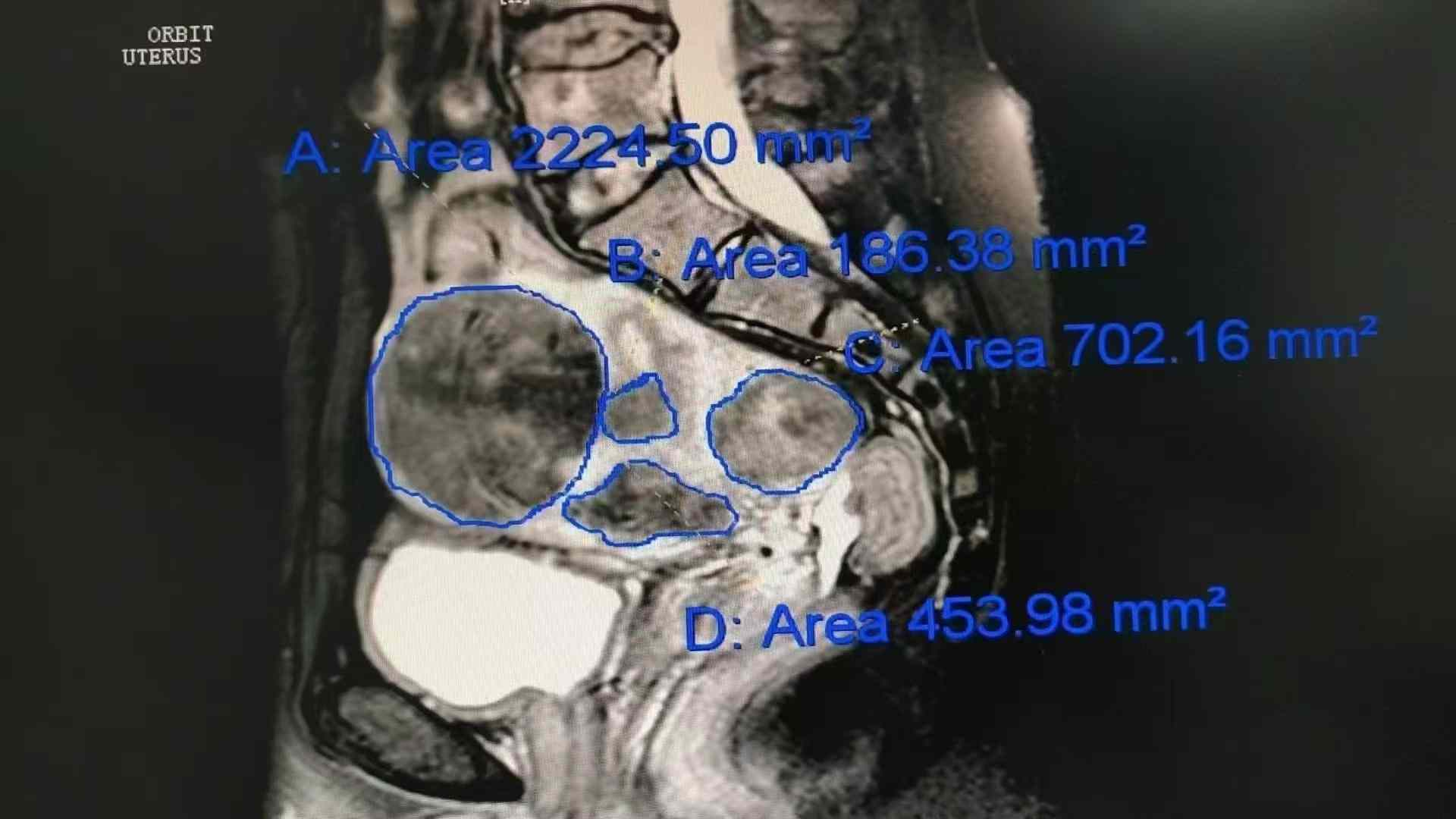 惊讶！493秒就搞定了多发性子宫肌瘤