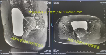 海扶刀和中医药联合怎样帮助妈妈圆上二胎梦！