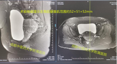 海扶刀和中医药联合怎样帮助妈妈圆上二胎梦！