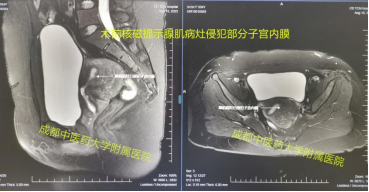 海扶刀和中医药联合怎样帮助妈妈圆上二胎梦！