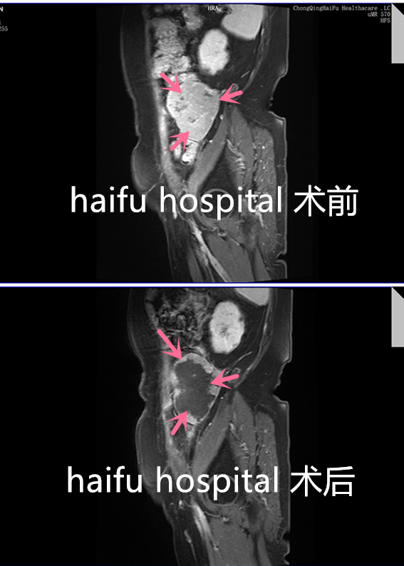 两次开腹手术后，盆腔平滑肌肉瘤再次复发，这次她选择……