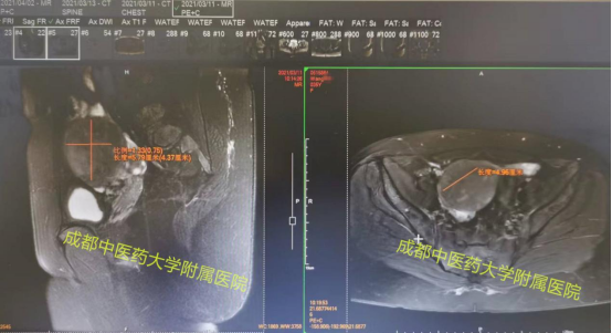 多次流产史女性终于圆上妈妈梦！