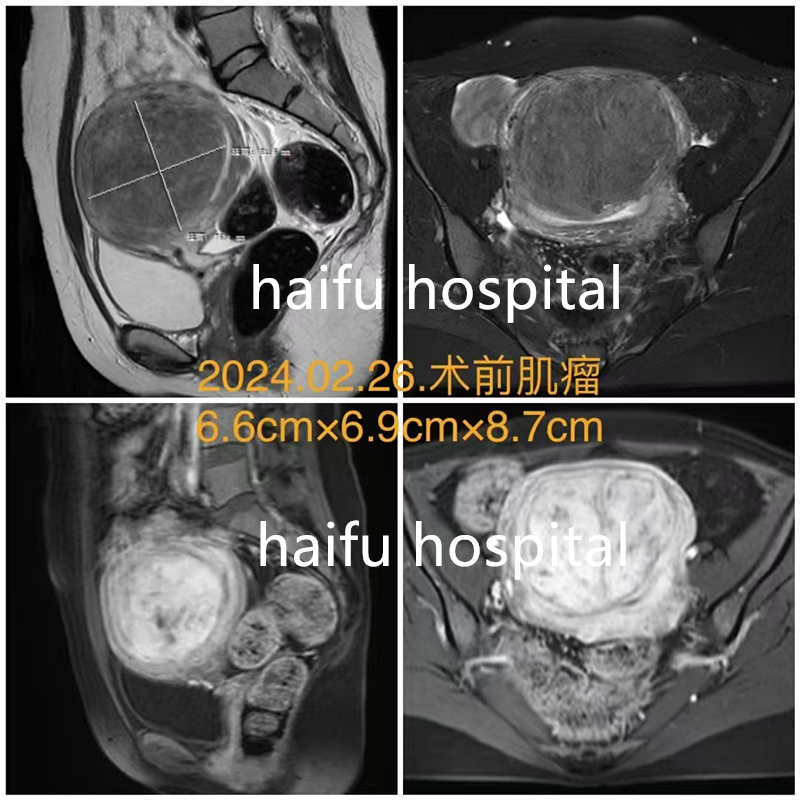 2次腹腔镜手术+2次自然流产   这位医生如何医治自己的肌瘤