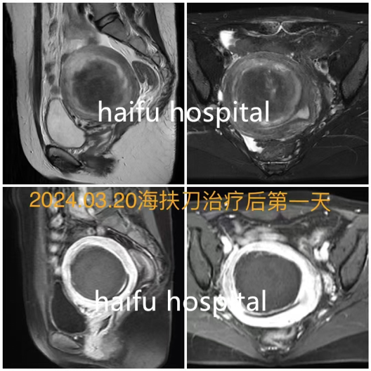 2次腹腔镜手术+2次自然流产   这位医生如何医治自己的肌瘤