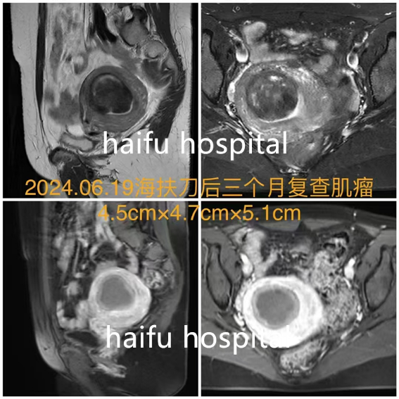 2次腹腔镜手术+2次自然流产   这位医生如何医治自己的肌瘤