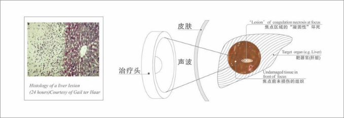 赣南医科大学第一附属医院海扶刀装机首年，乳腺无创手术突破500例