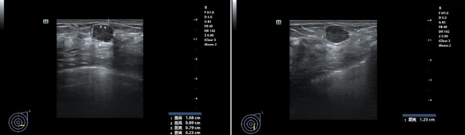 赣南医科大学第一附属医院海扶刀装机首年，乳腺无创手术突破500例