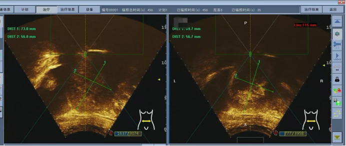 重庆红岭医院成功实施首例无创伤聚焦超声消融手术治疗子宫肌瘤