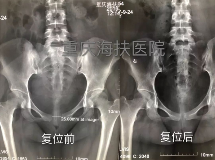 趾骨联合分离：一种产后难以言喻的痛