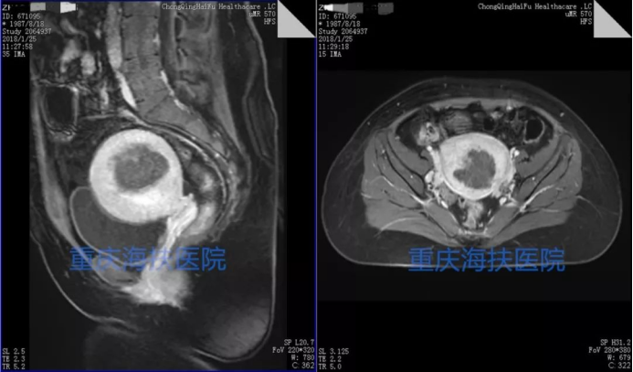 多囊与子宫腺肌病患者的双胞胎奇迹