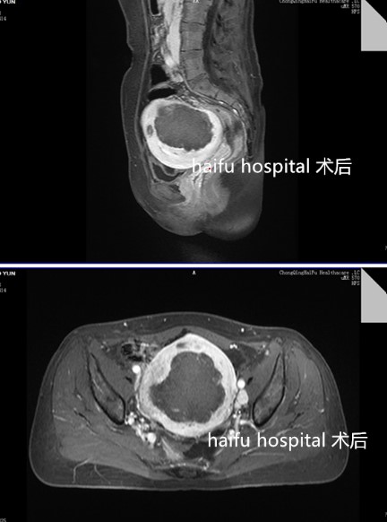 开腹挖腺肌病病灶后又面临切子宫，她会如何选择