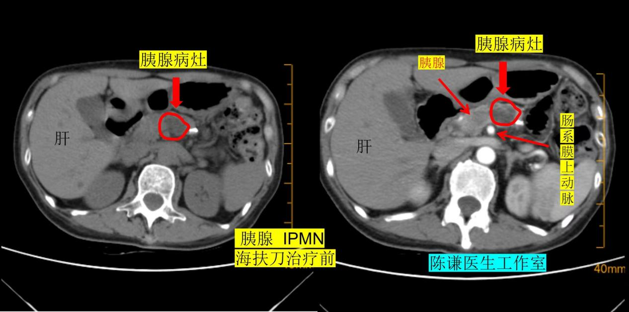72 岁北京老人跨省求医:胰腺 IPMN 不用开刀,4 个月肿瘤缩小80% 72 岁北京老人跨省求医:胰腺 IPMN 不用开刀,4 个月肿瘤缩小80%