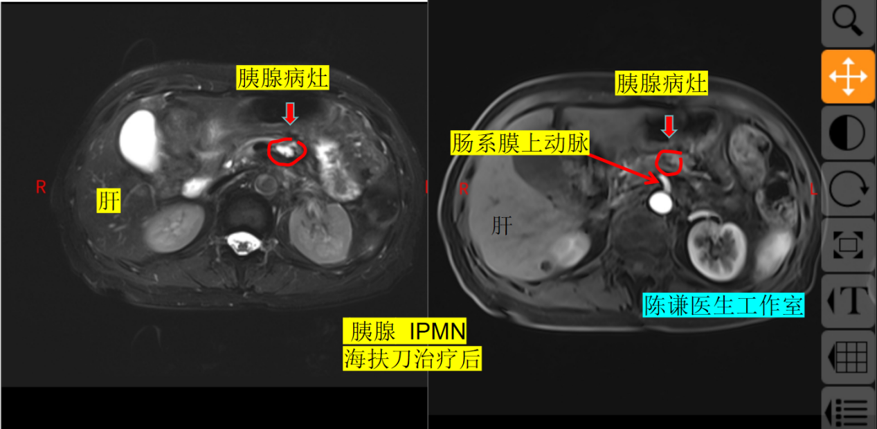 72 岁北京老人跨省求医:胰腺 IPMN 不用开刀,4 个月肿瘤缩小80% 72 岁北京老人跨省求医:胰腺 IPMN 不用开刀,4 个月肿瘤缩小80%