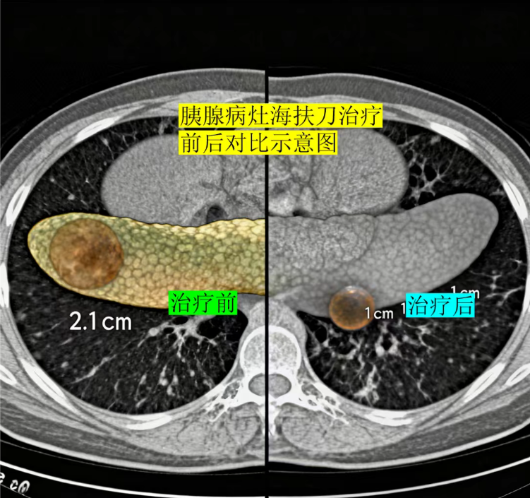72 岁北京老人跨省求医:胰腺 IPMN 不用开刀,4 个月肿瘤缩小80% 72 岁北京老人跨省求医:胰腺 IPMN 不用开刀,4 个月肿瘤缩小80%