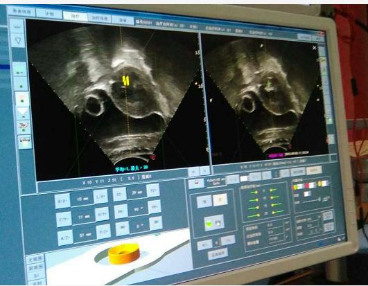 内蒙古首例HIFU治疗顺利完成！