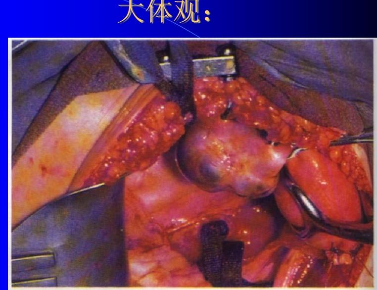 开腹手术中子宫腺肌症