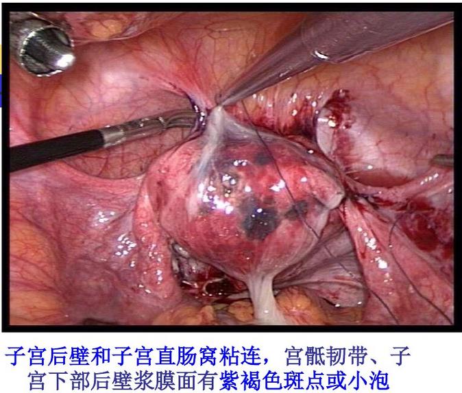 腹腔镜下子宫腺肌症合并盆腔子宫内膜异位症