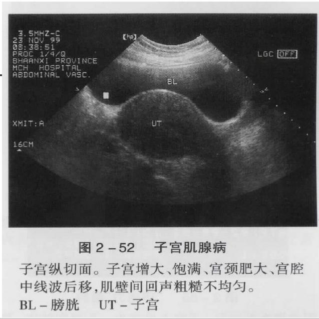 B超下看见的子宫腺肌症