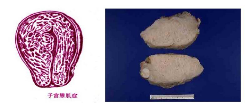 子宫腺肌症解剖图