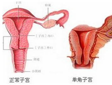 常见的几种子宫发育异常情况
