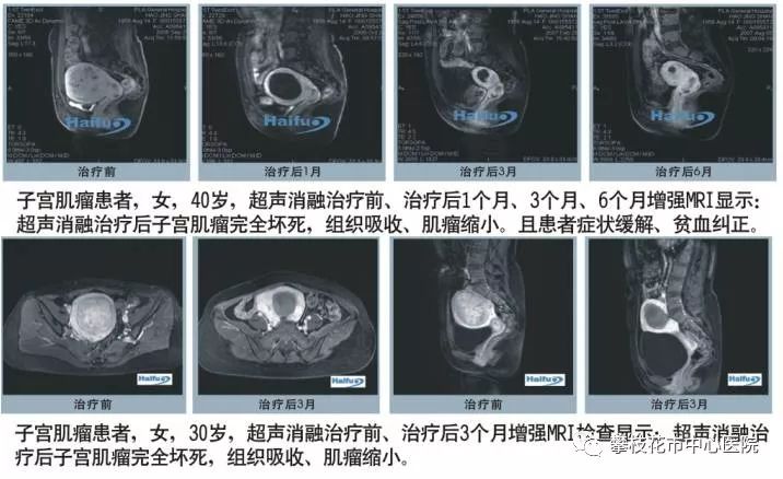 不开刀治疗子宫肌瘤和子宫腺肌症——海扶“刀”