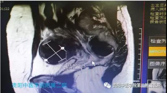 赞！贵阳地区第一例子宫肌瘤HIFU治疗在我院顺利完成