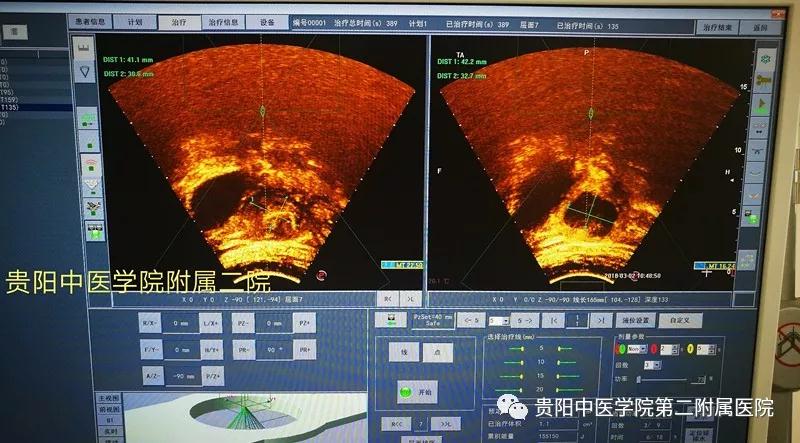 赞！贵阳地区第一例子宫肌瘤HIFU治疗在我院顺利完成